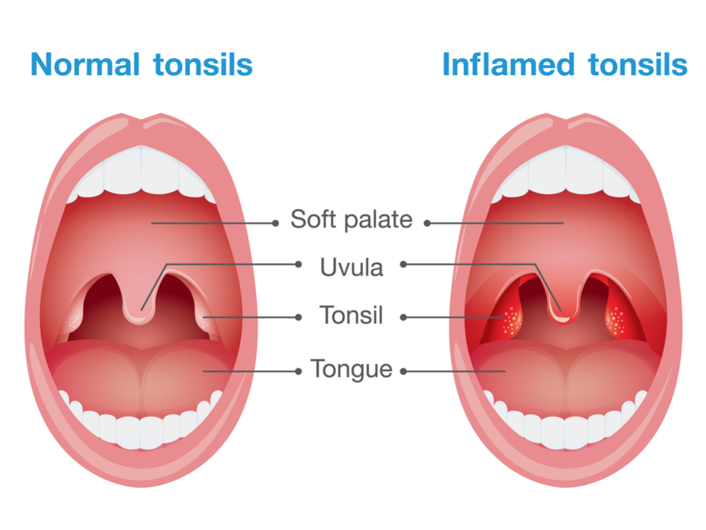 Tonsil cancer