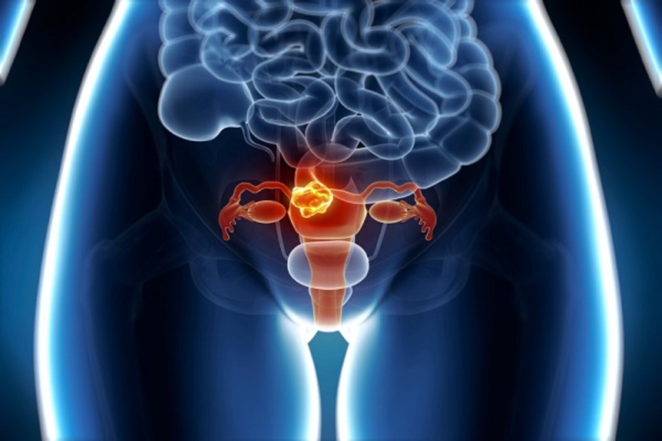 Uterus cancer