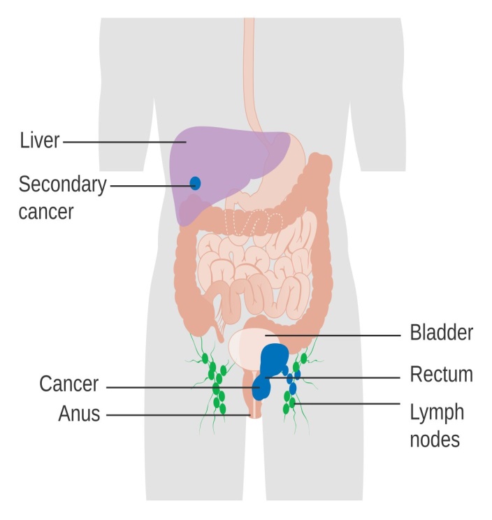 What is Anal-Cancer|Causes|Symptoms