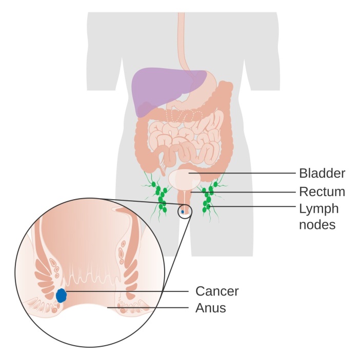 What is Anal-Cancer|Causes|Symptoms