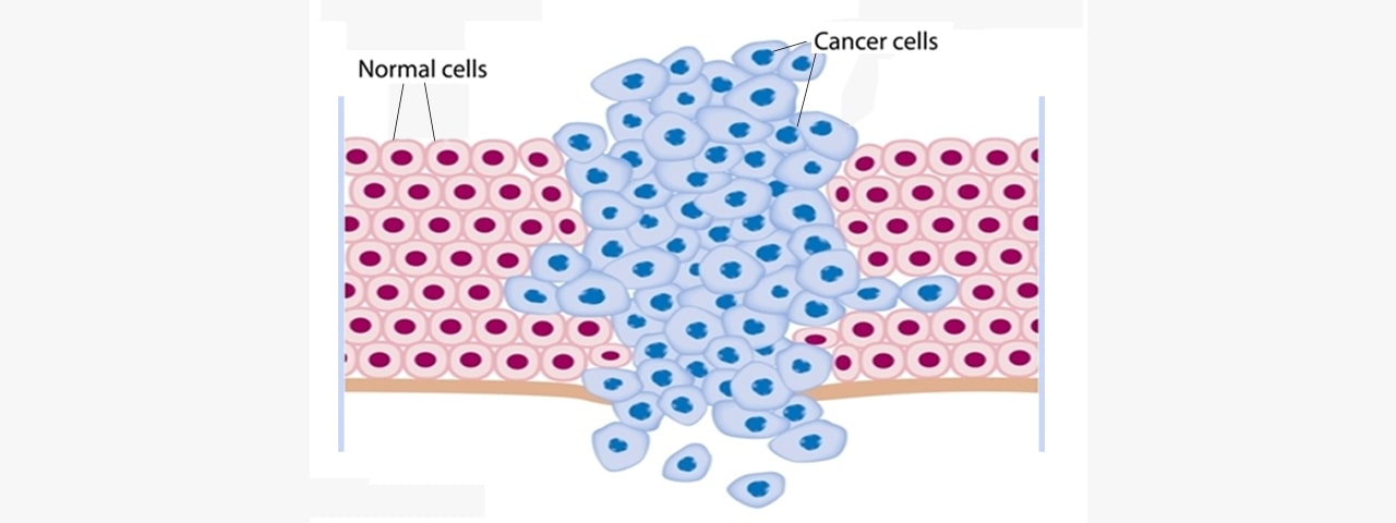 Esophageal cancer