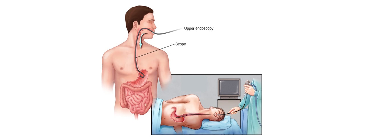 Esophageal cancer