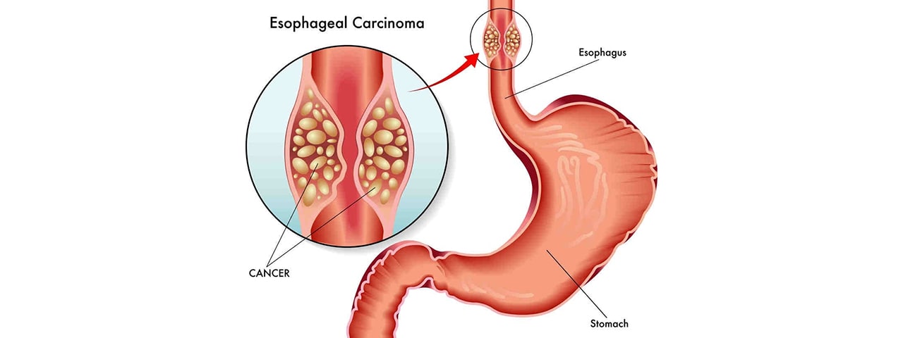 Esophageal cancer