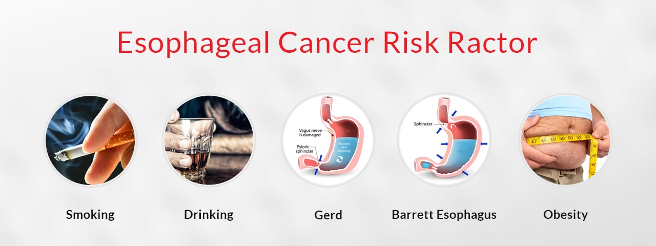 Esophageal cancer