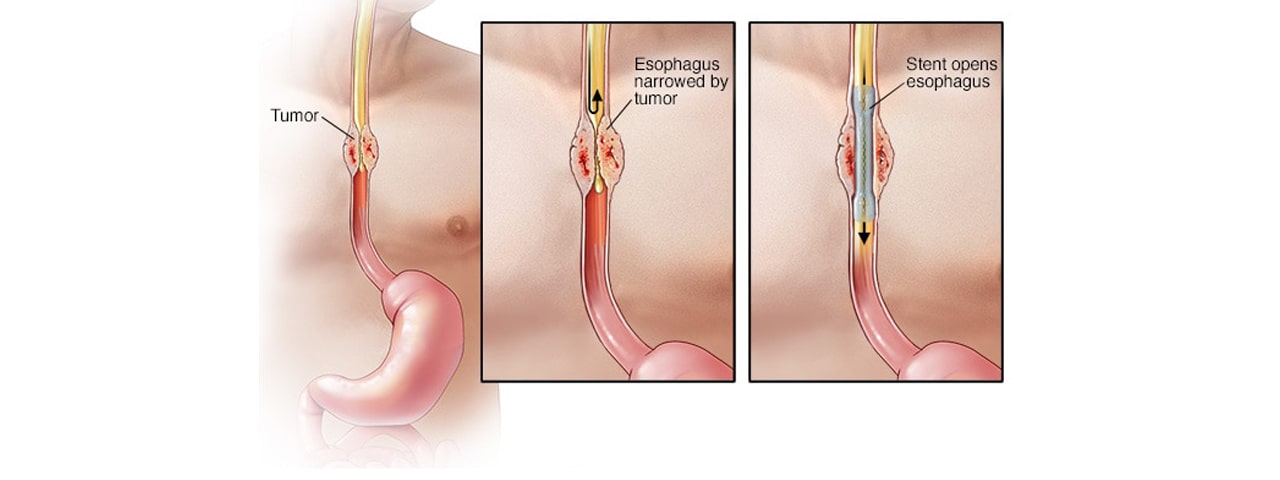 Esophageal cancer