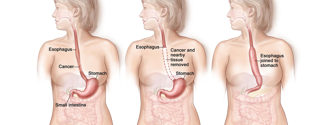 Esophageal cancer