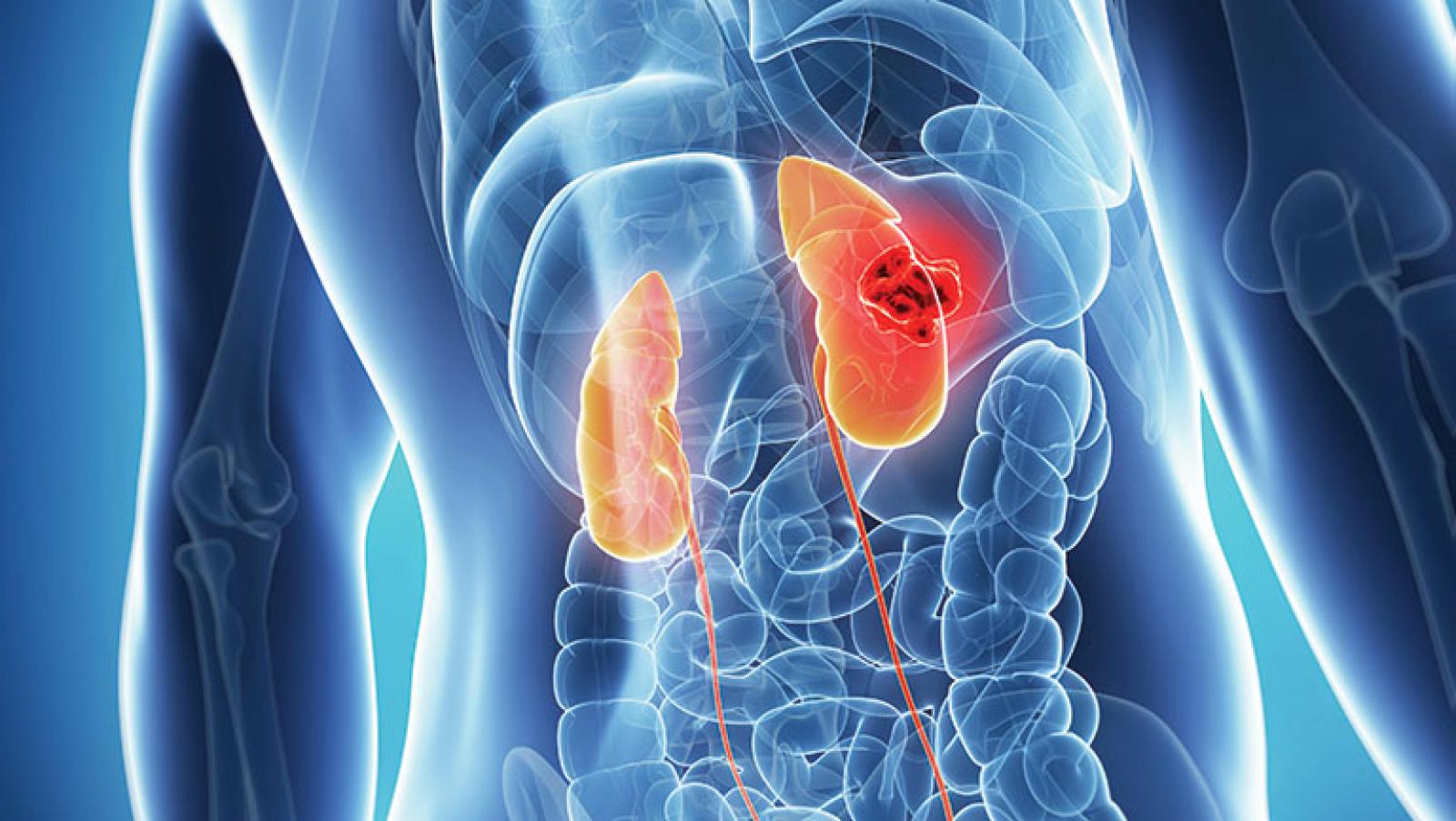 kidney cancer