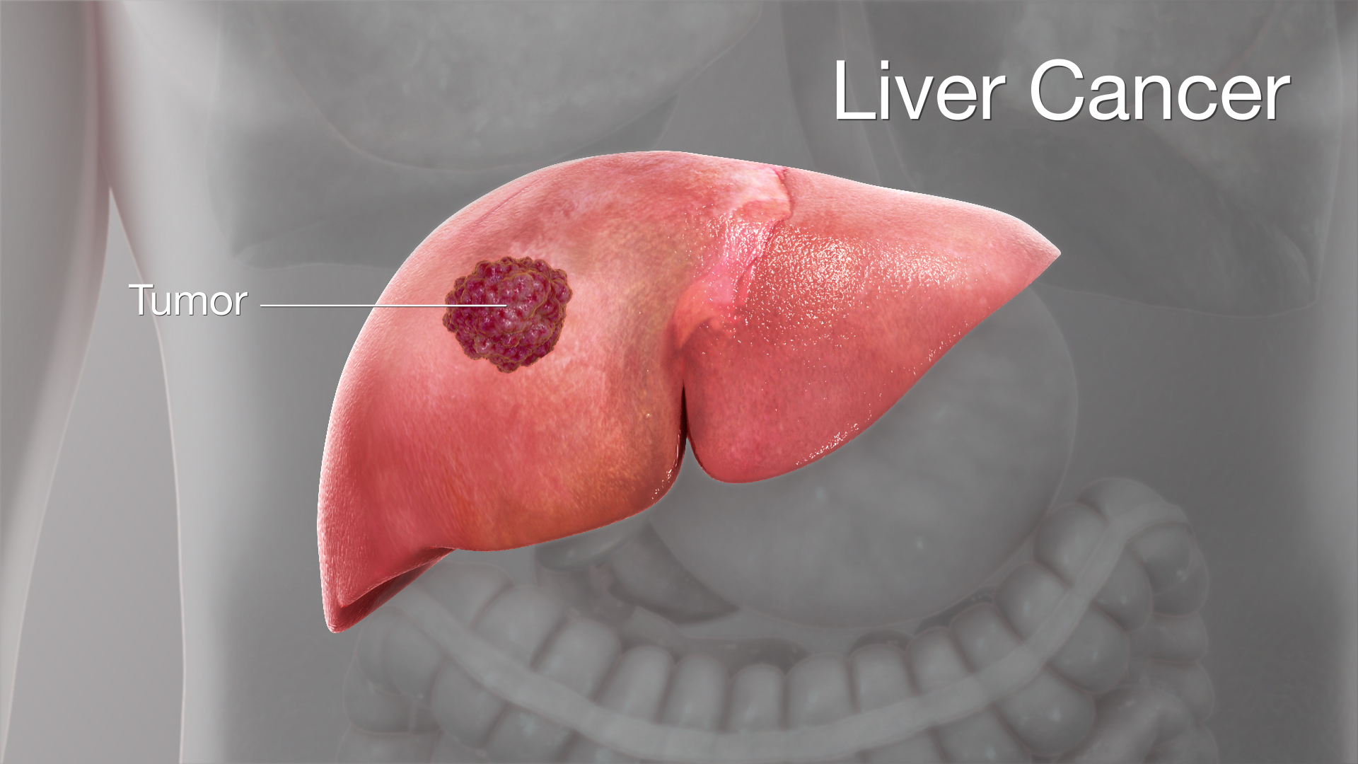 liver cancer